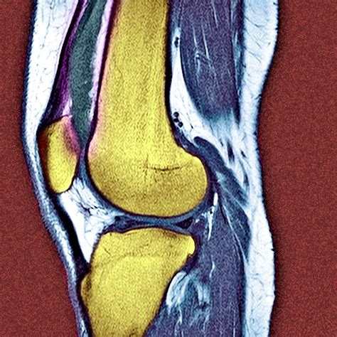 Knee Effusion Photograph By Du Cane Medical Imaging Ltd Fine Art America