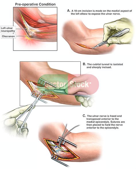 Ulnar Nerve Entrapment Injury With Surgical Transposition Doctor Stock