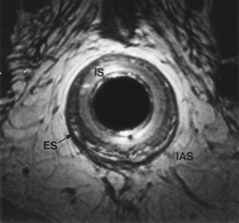 Endoanal Mr Imaging Of The Anal Sphincter In Fecal Incontinence