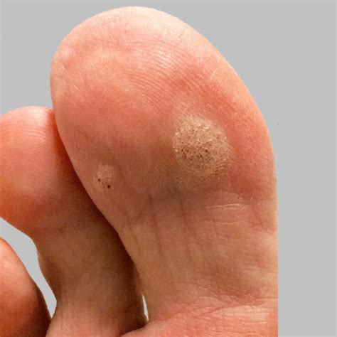 How To Determine If You Have A Plantar Wart Dr Nicholas Campitelli