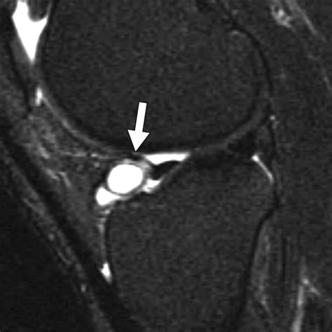 Association Of Parameniscal Cysts With Underlying Meniscal Tears As Identified On MRI And