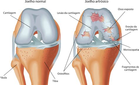 Artrose do joelho Ortoprime Ortopedia Brasília DF