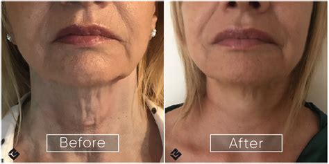 Results Endolift Laser Uk Non Surgical Facelift And Body Contouring