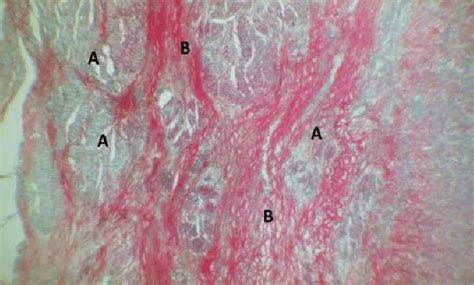 Photomicrograph Of Ovine Esophagus Section Showing Sever Hyperplasia In