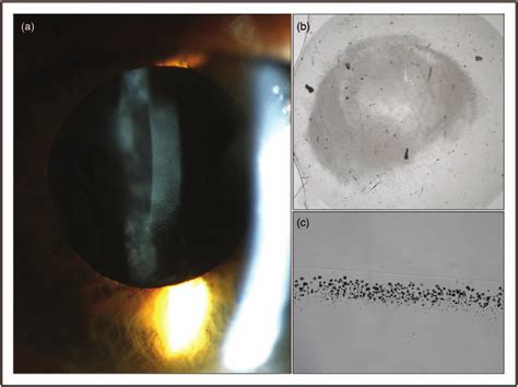 Cases Of Intraocular Lens Calcification A Clinical Photograph