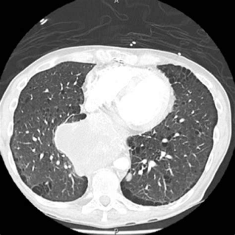 Thoracic Computed Tomography Without Contrast Showing A Retrocardiac