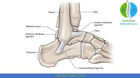 Lateral Ankle Sprain Orthofixar 2023