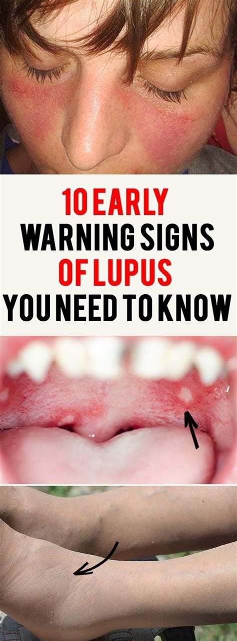 Early Signs Of Lupus You Need To Know Lupus Symptoms Lupus Disease