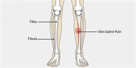 Shin Splints American Foot And Ankle
