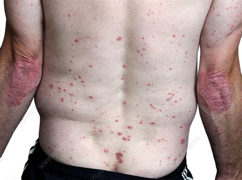 Psoriasis Stock Image C0238948 Science Photo Library