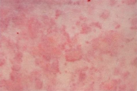 Urticaria Hives Concise Medical Knowledge