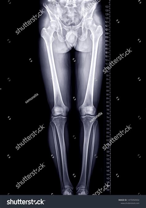 Scanogram Fulllength Standing Ap Radiograph Both Stock Illustration