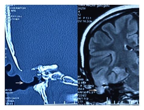 Mri And Ct Images Of The Tegmen Defect And Herniated Brain Tissue