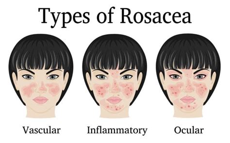 Guide To Ocular Rosacea Treatment And More Nvision Eye Centers