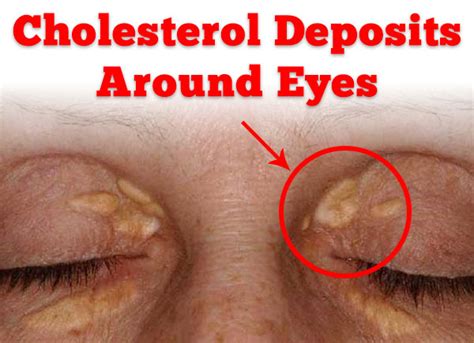Cholesterol Deposits On Eyelids Around Eyes Xanthelasma Dr Sam