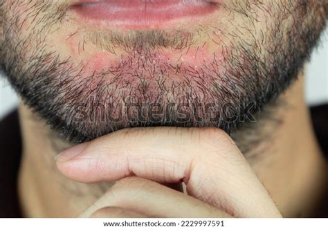 Seborrheic Dermatitis Beard Eczema On Male Stock Photo 2229997591
