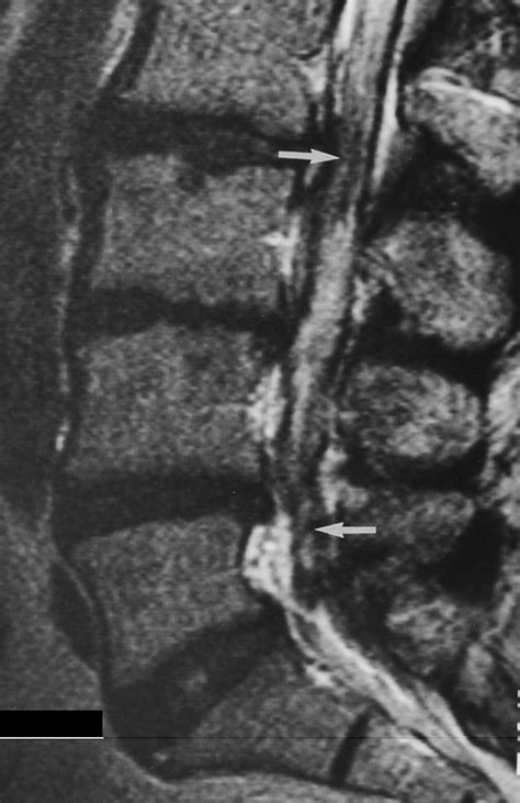 Arachnoiditis Ossificans Mr Imaging Features In Five Patients Ajr