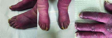 Patient 1 Swelling And Erythema On Bilateral Hands And Feet