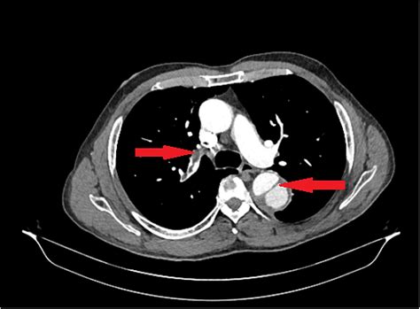 Cureus Simultaneous Aortic Dissection And Pulmonary Embolism A
