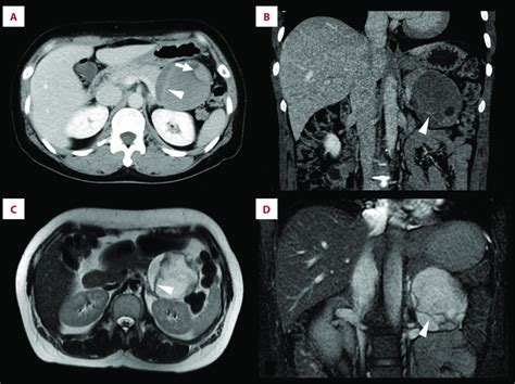 Enhanced Computed Tomography Ct And T2 Weighted Magnetic Resonance