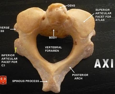 What Is The Difference Between Atlas And Axis Vertebrae Pediaacom