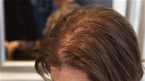 As They Age Women Lose Their Hair Too