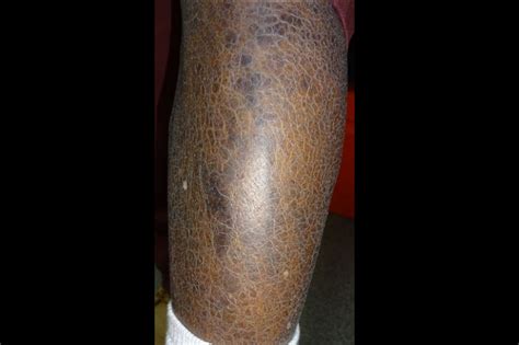 Derm Dx Xerosis With A Fish Scale Pattern Clinical Advisor