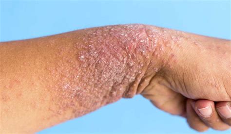 Dermatitis At Pica Una Enfermedad M S All De La Piel
