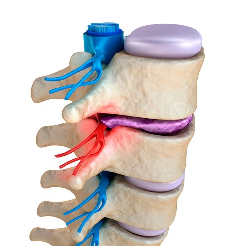 What Is A Pinched Nerve And The Treatment Options