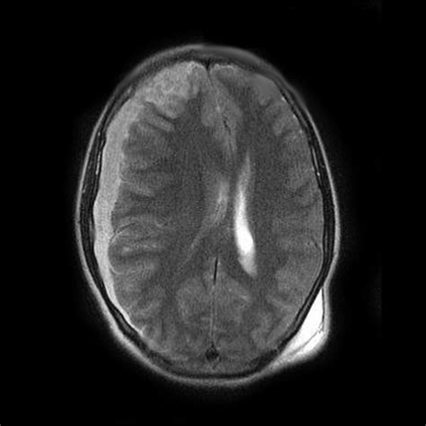 Dating Subdural Hematoma Mri Telegraph