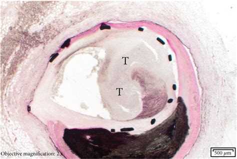 Transmural Acute Inflammation And Intraluminal Organizing Thrombus T