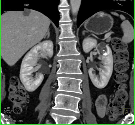 Bosniak 2f Cyst Left Kidney Kidney Case Studies Ctisus Ct Scanning