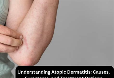 Causes Of Atopic Dermatitis Archives Drshridevi Lakhe