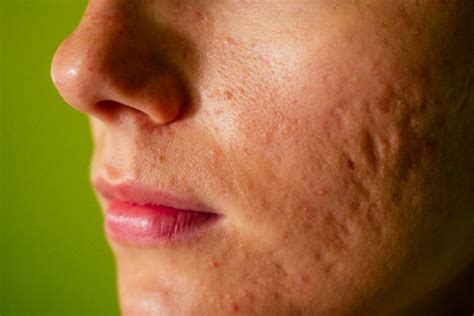 Microneedling Ice Pick Acne Scar Treatment A Detailed Guide