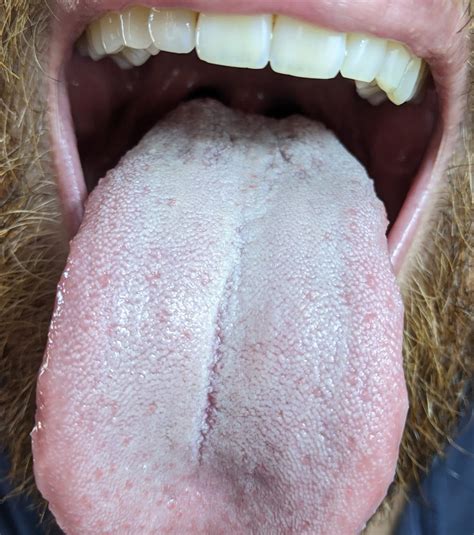 White Tongue And Bad Taste For Years Dentistry