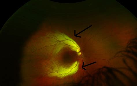 Cureus Ocular Findings Associated With Myelinated Retinal Nerve Fibers