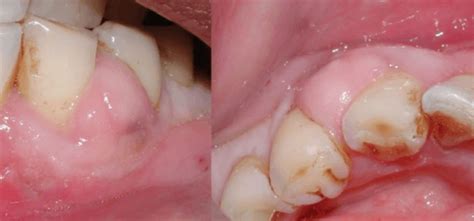 O Que é Abscesso Dentário Tratamento Sintomas Antibiótico Causas