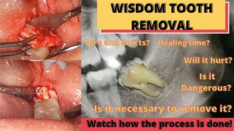 Wisdom Tooth Removal Processsurgery And All Things You Need To Know