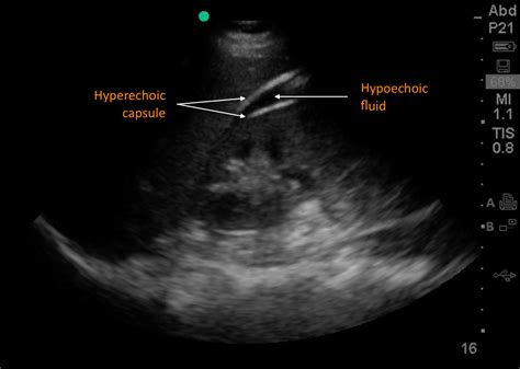 Cureus Isolated Renal Laceration On Point Of Care Ultrasound