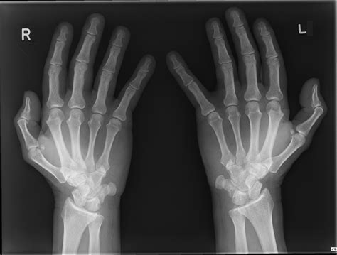 Hand X Ray Related Keywords And Suggestions Hand X Ray Long Tail Keywords