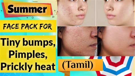 தமிழில் Heat Pimples On Face Home Remedy Summer Skin Care At Home