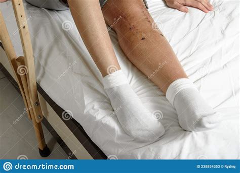 Female Patient With Postoperative Suture After Surgery On Broken Leg