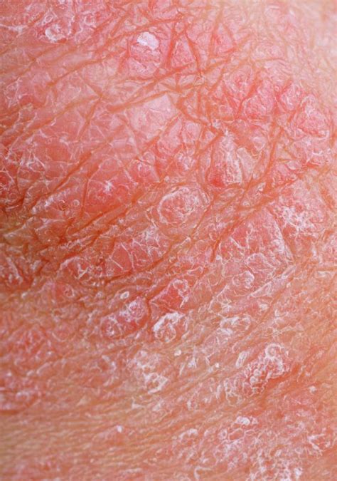 What Are The Different Contact Dermatitis Treatments