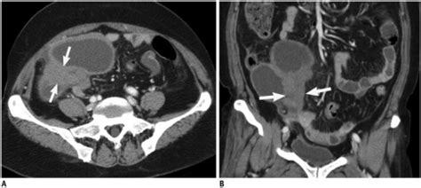 Contrast Enhanced Computed Tomography Ct Scan Of 66 Y Open I