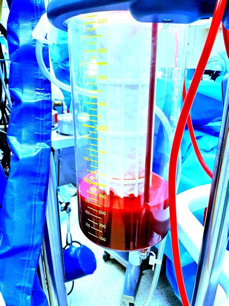 Preoperative Anemia And Transfusion In Cardiac Surgery A Single Centre