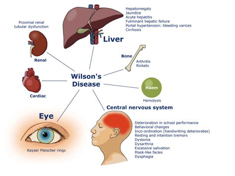 Wilson Disease