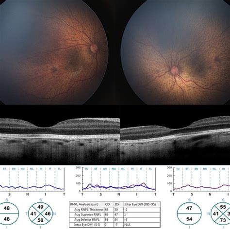 Sd Oct Scan Findings A Wide Field Retinal Imaging Showing