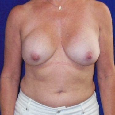 Before After Breast Reconstruction Bilateral Mastectomies Photos