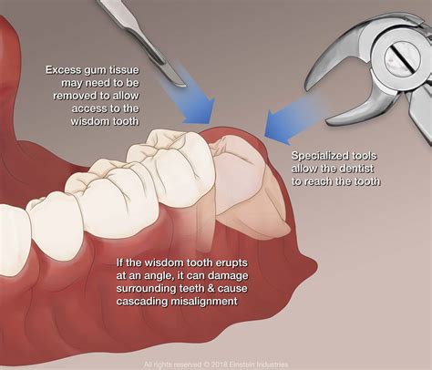 However, you can eliminate pain and have a generally painless procedure by letting your dentist use the right anesthesia for you. Wisdom Teeth Removal Scottsdale, AZ - Phoenix, AZ - Dental ...