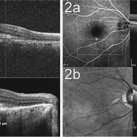 Use Of Multimodal Imaging To Localize The Neovascular Lesion 1a Cnv